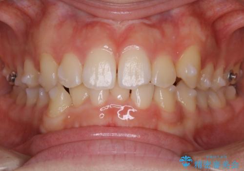 【非抜歯】すきっ歯と噛み合わせの治療の治療中