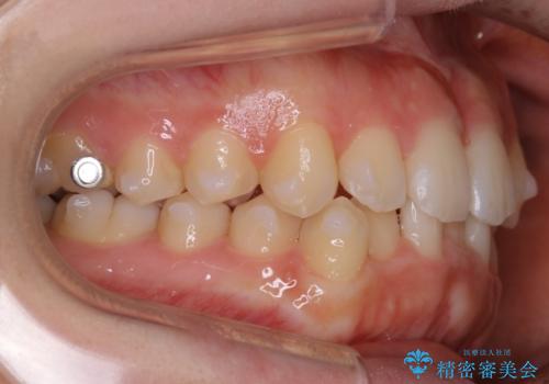 【非抜歯】すきっ歯と噛み合わせの治療の治療中