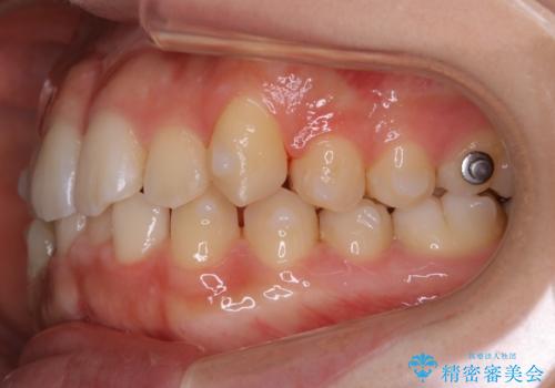 【非抜歯】すきっ歯と噛み合わせの治療の治療中