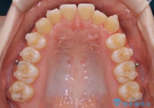 【非抜歯】すきっ歯と噛み合わせの治療の治療中