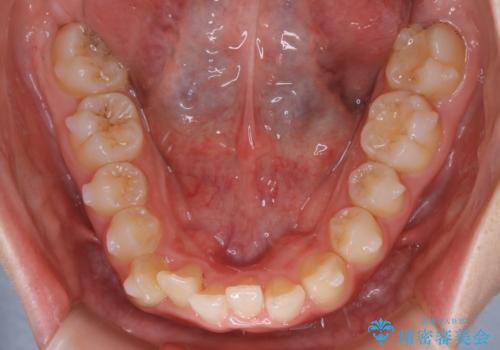 【非抜歯】すきっ歯と噛み合わせの治療の治療中