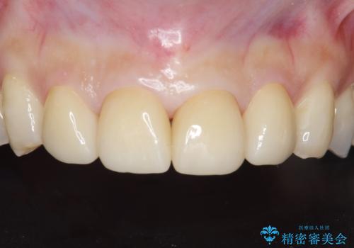 前歯をきれいな被せ物にしたい。の症例 治療後