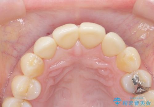 前歯をきれいな被せ物にしたい。の治療後