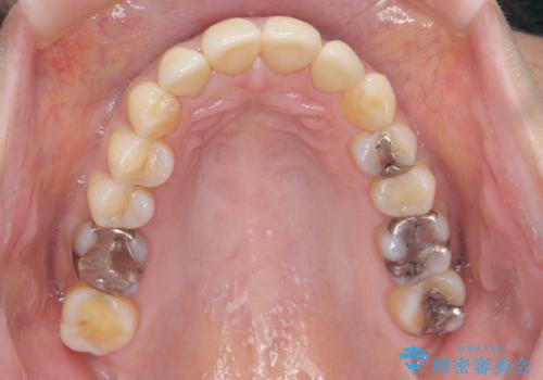 前歯をきれいな被せ物にしたい。の治療後