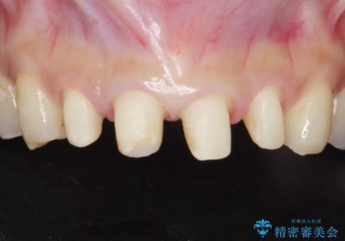 前歯をきれいな被せ物にしたい。の治療中