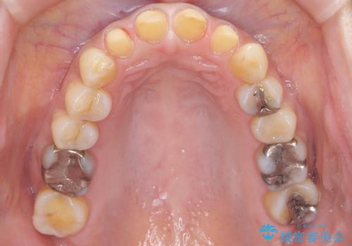 前歯をきれいな被せ物にしたい。の治療中