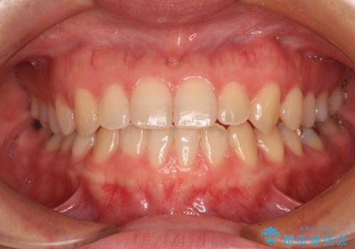 前歯のクロスバイト　インビザラインによる矯正治療の症例 治療後