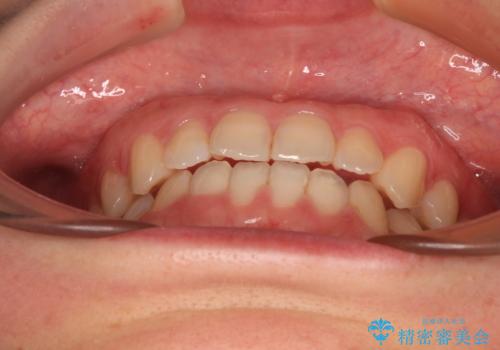 前歯のクロスバイト インビザラインによる矯正治療の治療後