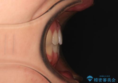 前歯のクロスバイト インビザラインによる矯正治療の治療後