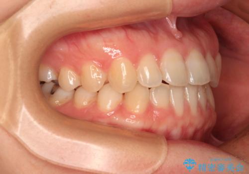 前歯のクロスバイト インビザラインによる矯正治療の治療後