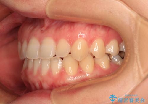 前歯のクロスバイト インビザラインによる矯正治療の治療後
