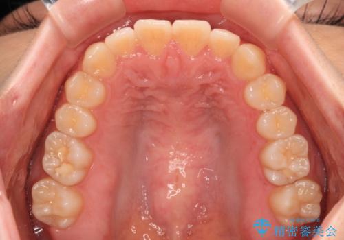 前歯のクロスバイト インビザラインによる矯正治療の治療後