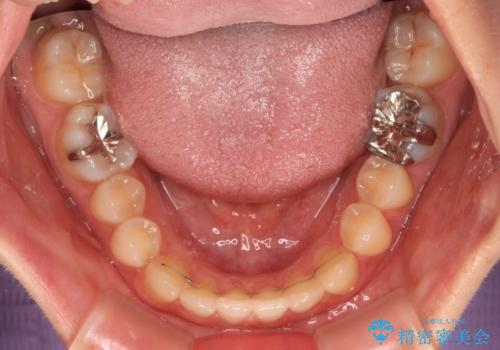 前歯のクロスバイト インビザラインによる矯正治療の治療後