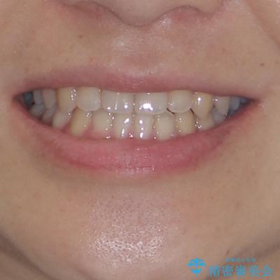 前歯のクロスバイト インビザラインによる矯正治療の治療後(顔貌)