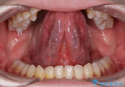 舌が動かしにくいの症例 治療後