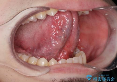 舌が動かしにくいの治療後