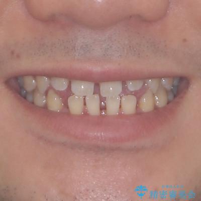 空隙歯列を閉じる 舌のトレーニングとワイヤー矯正の治療前(顔貌)