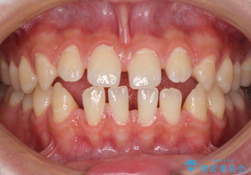 空隙歯列を閉じる 舌のトレーニングとワイヤー矯正の治療前