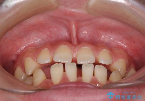 空隙歯列を閉じる 舌のトレーニングとワイヤー矯正の治療前