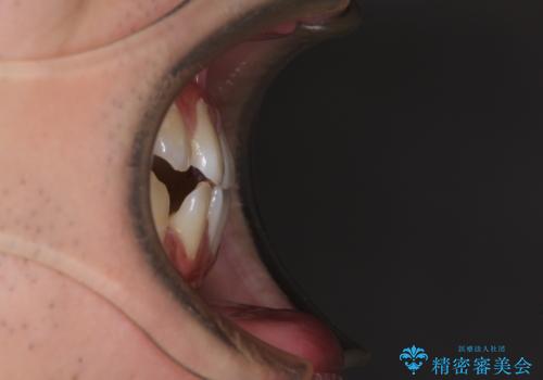 空隙歯列を閉じる　舌のトレーニングとワイヤー矯正の治療前