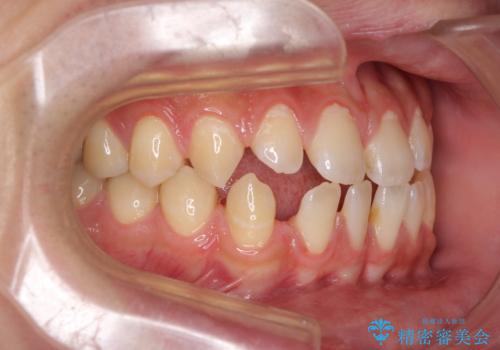 空隙歯列を閉じる　舌のトレーニングとワイヤー矯正の治療前