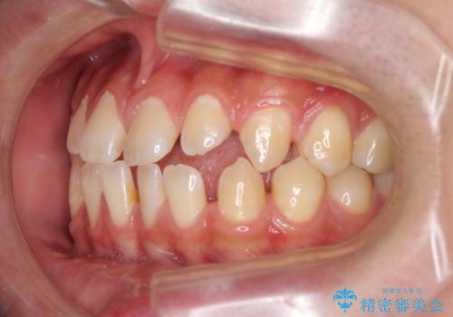 空隙歯列を閉じる 舌のトレーニングとワイヤー矯正の治療前