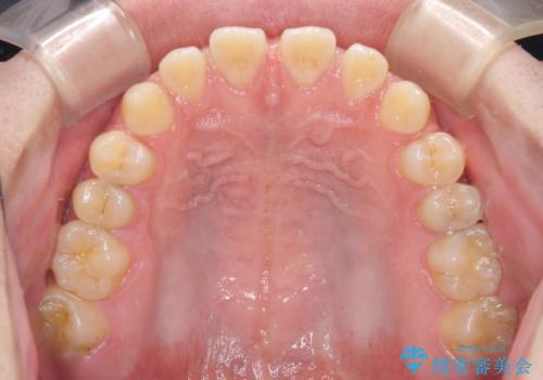 空隙歯列を閉じる 舌のトレーニングとワイヤー矯正の治療前
