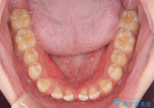 空隙歯列を閉じる 舌のトレーニングとワイヤー矯正の治療前