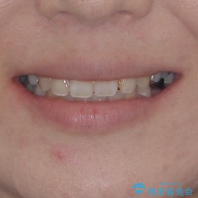 インビザラインが続けられない 装置変更して抜歯矯正の治療後(顔貌)