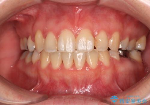 インビザラインが続けられない 装置変更して抜歯矯正の症例 治療後