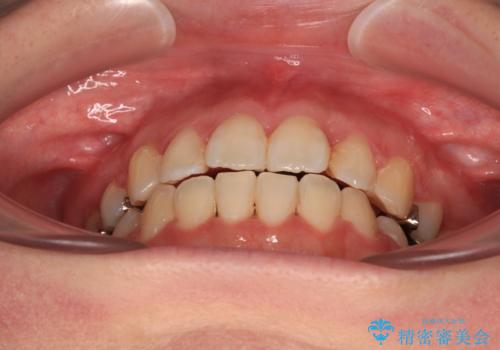 インビザラインが続けられない　装置変更して抜歯矯正の治療後