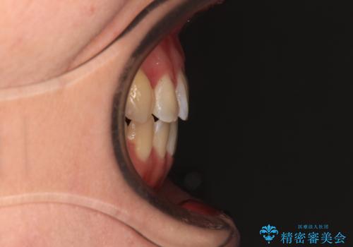 インビザラインが続けられない 装置変更して抜歯矯正の治療後