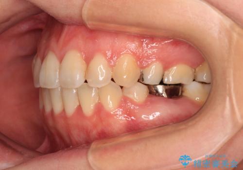 インビザラインが続けられない　装置変更して抜歯矯正の治療後