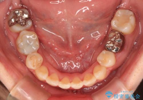 インビザラインが続けられない 装置変更して抜歯矯正の治療後