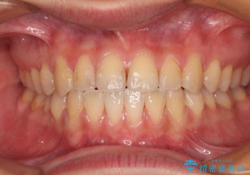 前歯のクロスバイトを治したい ワイヤー装置による矯正治療の治療後