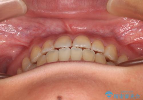 前歯のクロスバイトを治したい ワイヤー装置による矯正治療の治療後