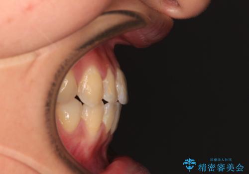 前歯のクロスバイトを治したい ワイヤー装置による矯正治療の治療後