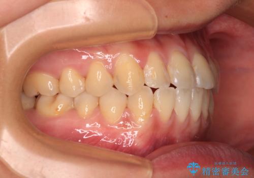 前歯のクロスバイトを治したい　ワイヤー装置による矯正治療の治療後