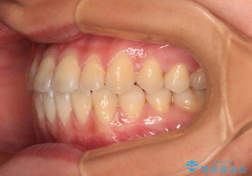 前歯のクロスバイトを治したい ワイヤー装置による矯正治療の治療後