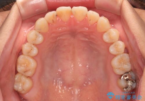 前歯のクロスバイトを治したい ワイヤー装置による矯正治療の治療後