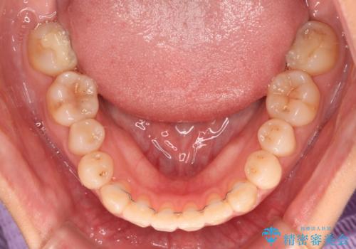 前歯のクロスバイトを治したい ワイヤー装置による矯正治療の治療後