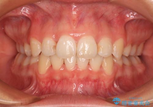 八重歯と乱れた咬み合わせを改善　ワイヤー装置での抜歯矯正の症例 治療後