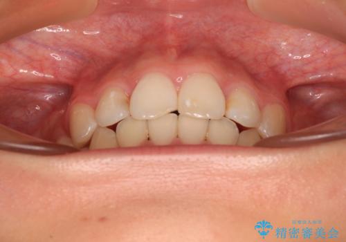 八重歯と乱れた咬み合わせを改善 ワイヤー装置での抜歯矯正の治療後