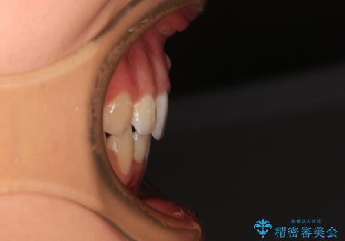 八重歯と乱れた咬み合わせを改善 ワイヤー装置での抜歯矯正の治療後