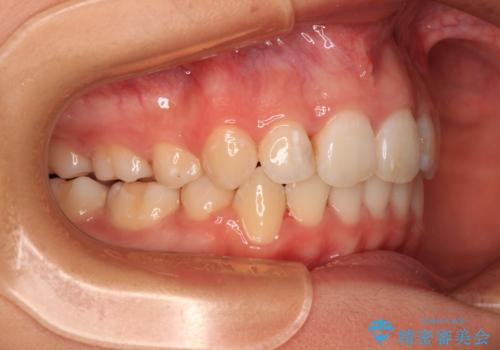 八重歯と乱れた咬み合わせを改善　ワイヤー装置での抜歯矯正の治療後