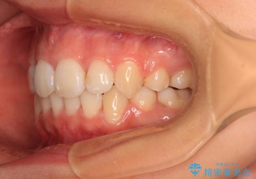八重歯と乱れた咬み合わせを改善　ワイヤー装置での抜歯矯正の治療後