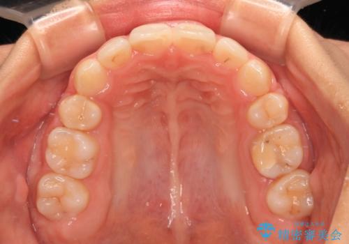八重歯と乱れた咬み合わせを改善 ワイヤー装置での抜歯矯正の治療後