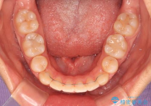 八重歯と乱れた咬み合わせを改善 ワイヤー装置での抜歯矯正の治療後