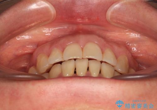 正中のズレと飛び出した前歯を改善 メタルブラケットでの抜歯矯正の治療後