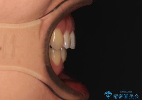 正中のズレと飛び出した前歯を改善 メタルブラケットでの抜歯矯正の治療後